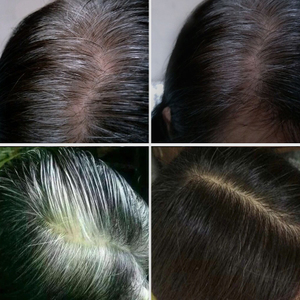 遗传性的头发所在问题 白头发