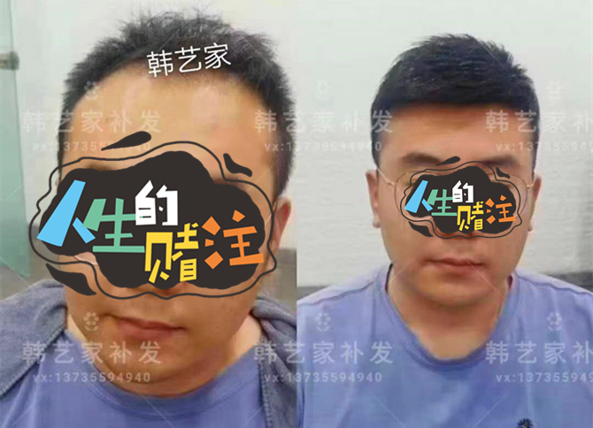 韩艺家无痕增发