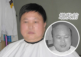 男士脱发案例