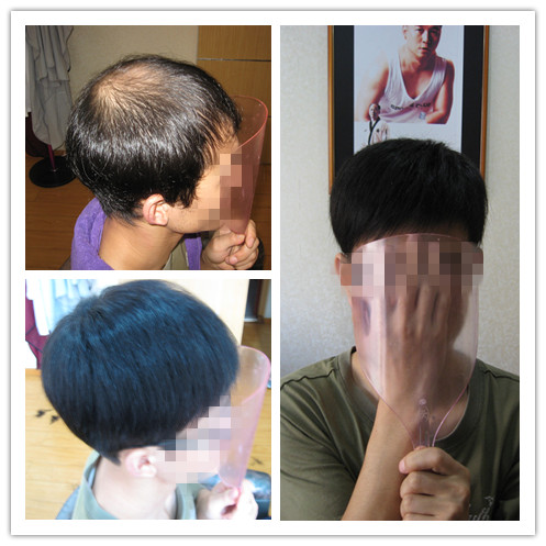 补发织发的客户使用哪种固定方式，最好？