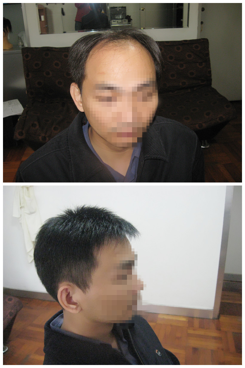 严重脱发怎么办呀