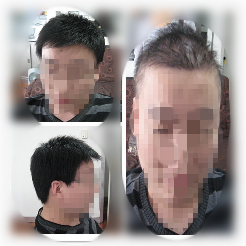 正确认识造成脱发的病因