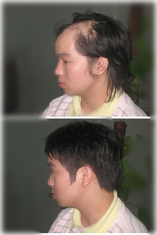 别沮丧脱发问题，试试用织发补发来解决你的毛发问题吧